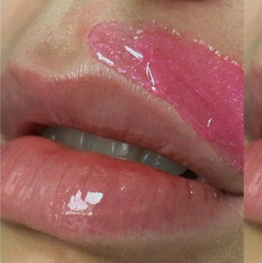 Удаление пушка над верхней губой