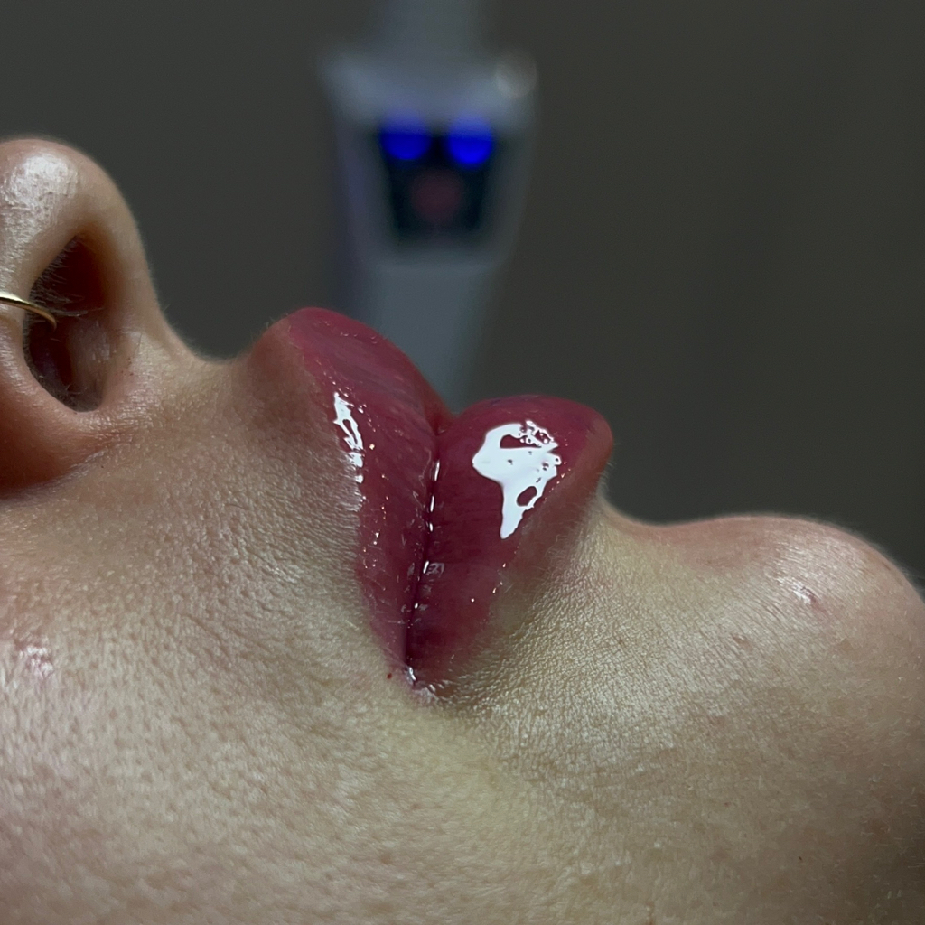 Увеличение губ 0,5