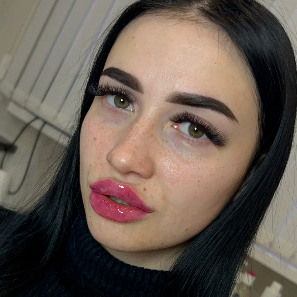 Увеличение губ 1 мл