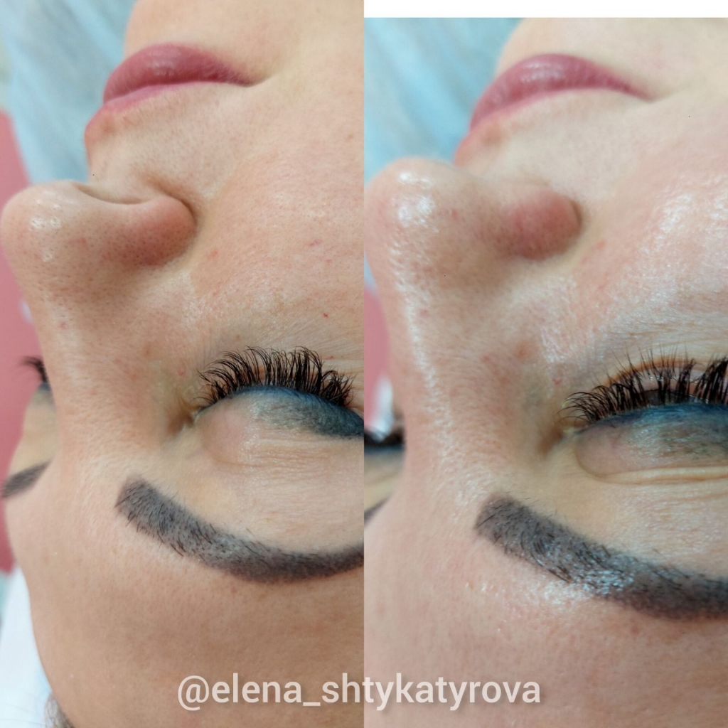 3Д Атравматичная чиска лица на космецевтике Демакс "Япония"