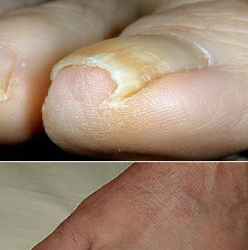 Педикюр + вросший ноготь