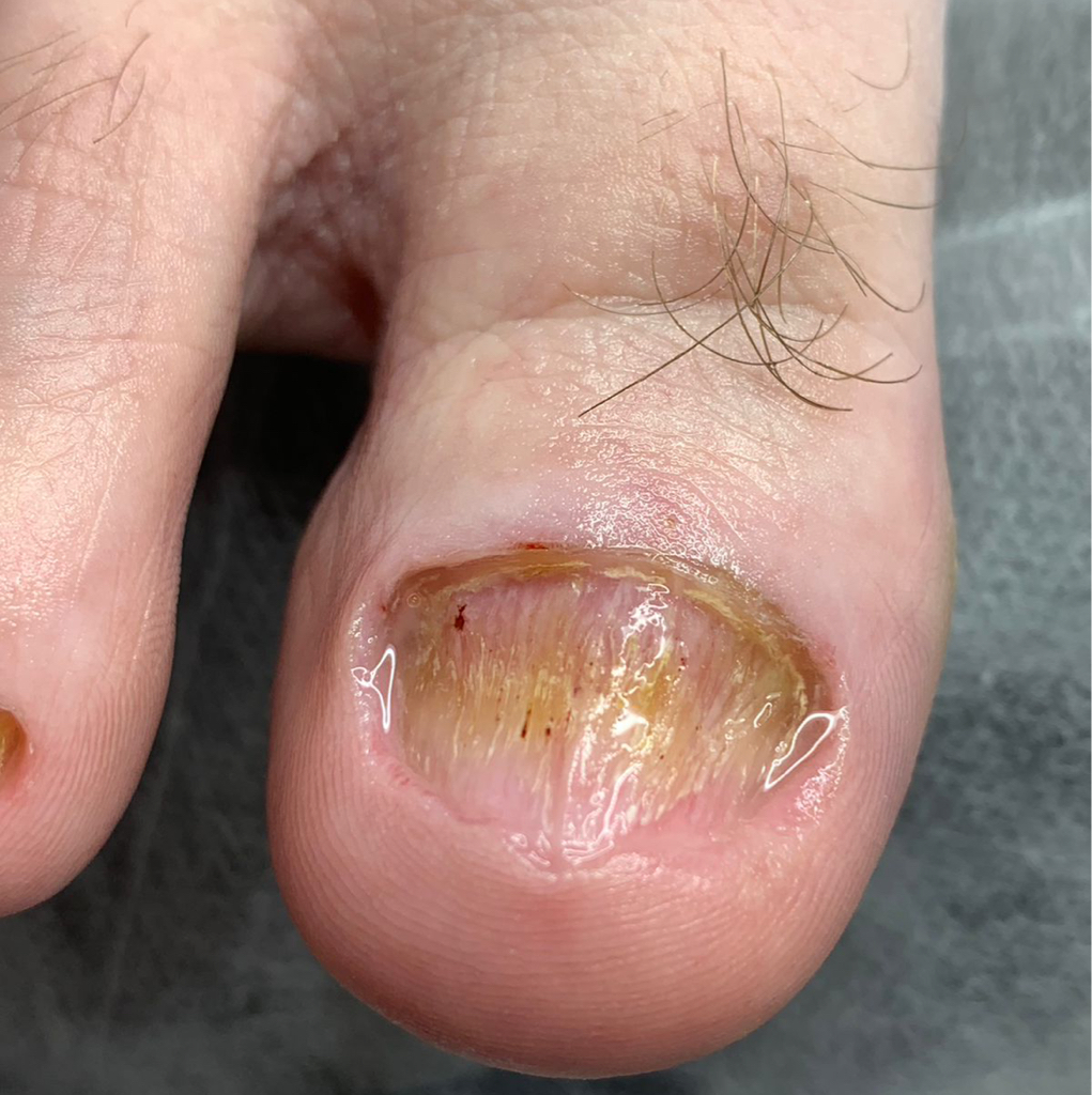 Зачистка грибкового ногтя, онихолизиса