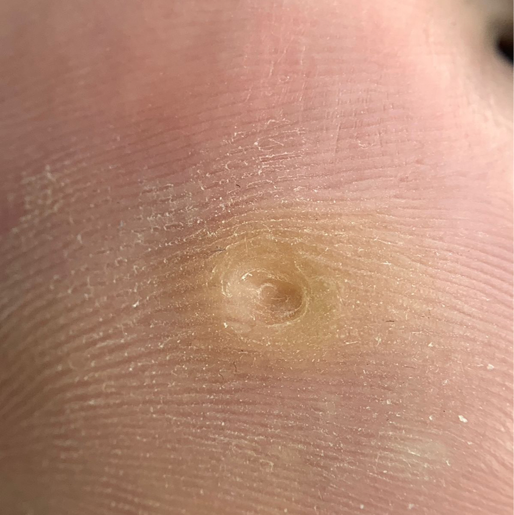 Стержневая мозоль