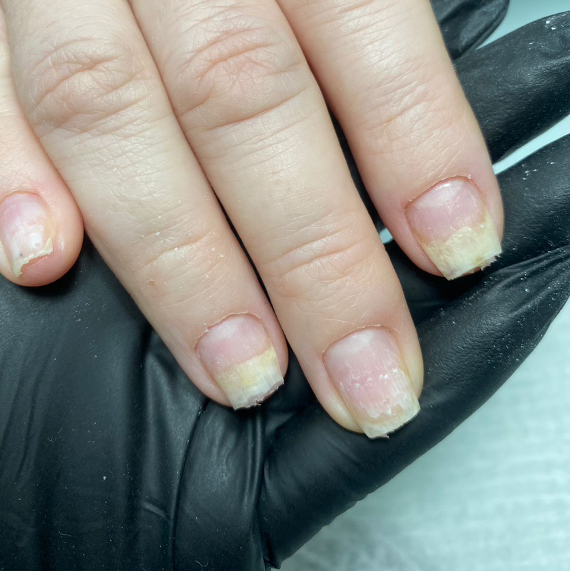 Зачистка онихолизиса  1 ноготь на руках + санация ногтевого ложа