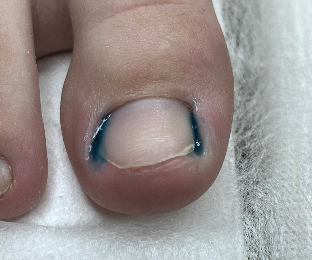 Установка тампонады