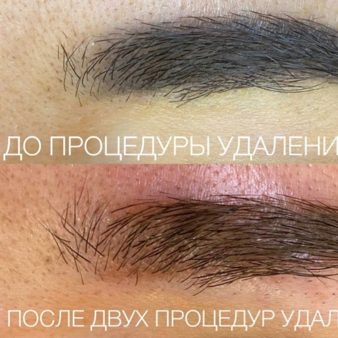 Удаления перманента