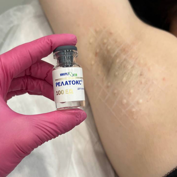 Лечение гипергидроза