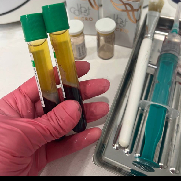 Плазмотерапия+Strong hair