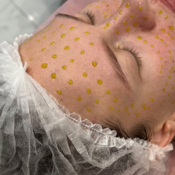 Аппаратная шлифовка+пилинг BioRepeel