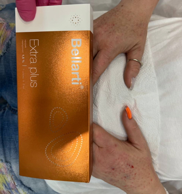 Биоревитализация рук