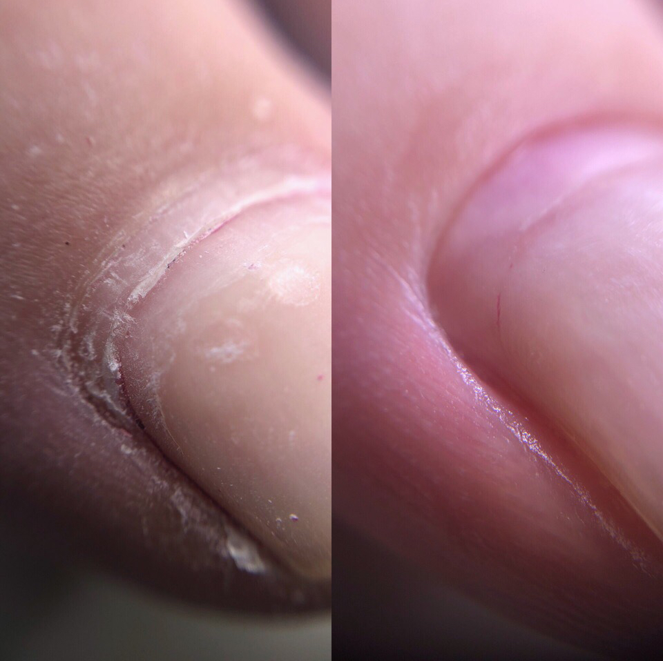 Обработка пальчиков и стоп