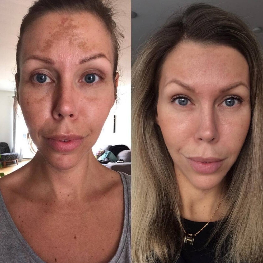 Программа " Коррекция пигментации"