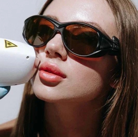 Лазерная эпиляция. Верхняя губа