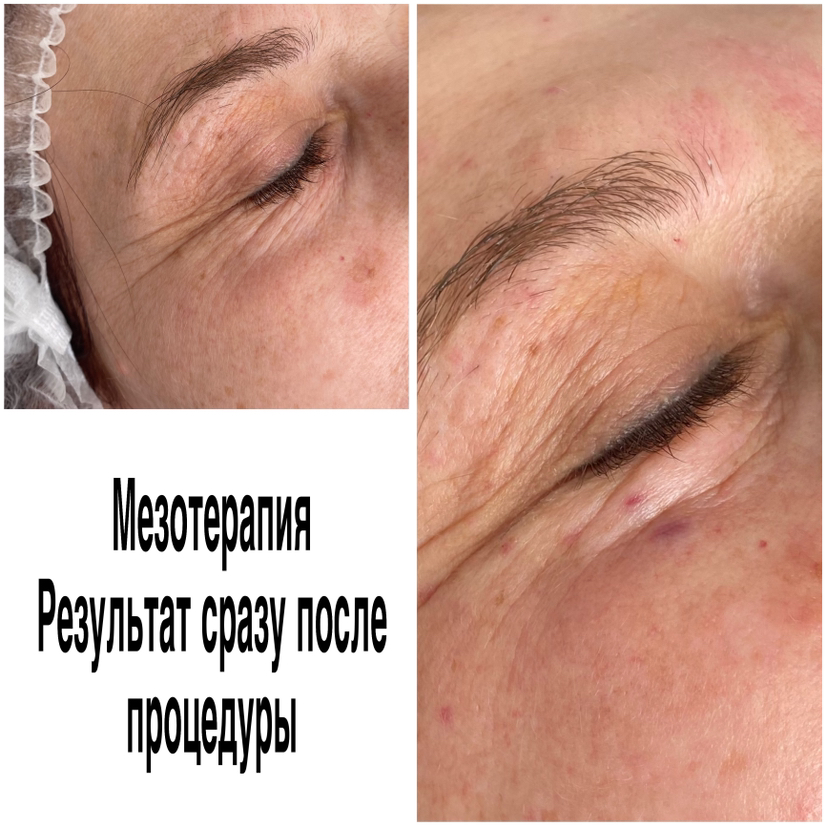 Мезотерапия