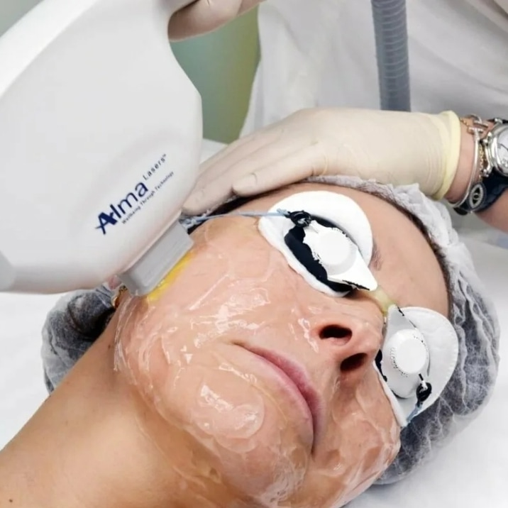 Elos омоложение