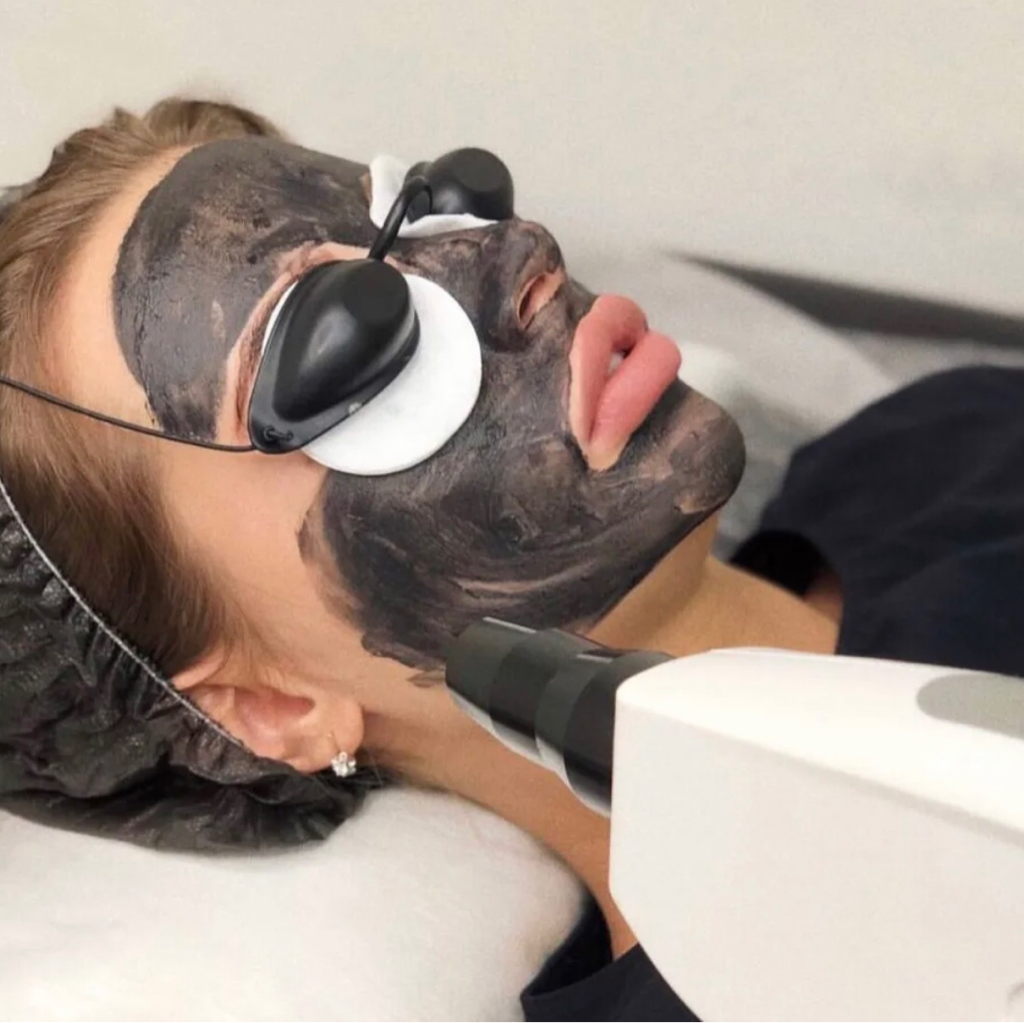 Карбоновый пилинг