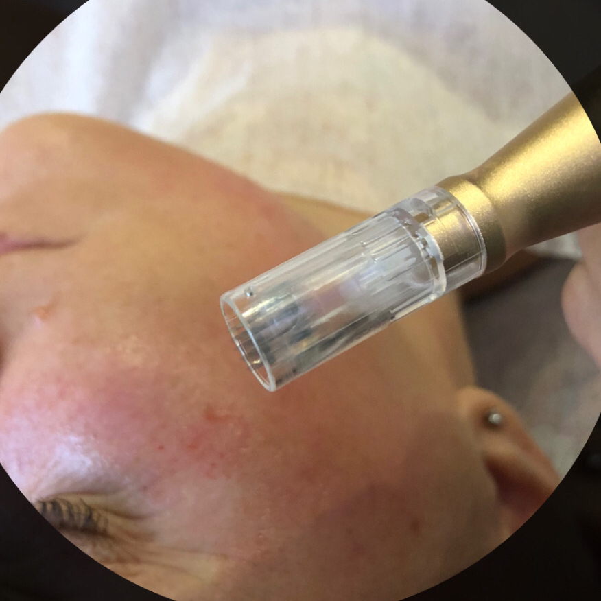 Фракционная мезотерапия