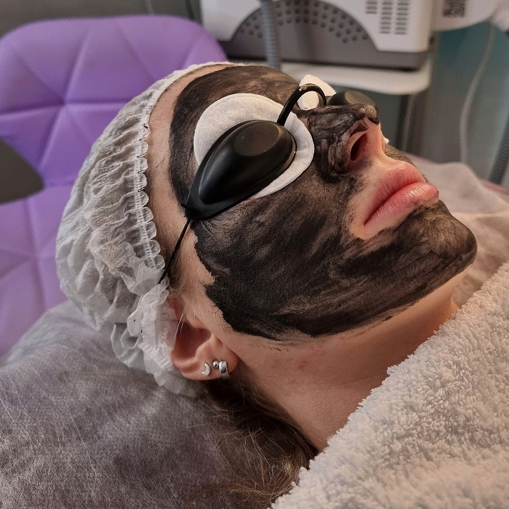 Карбоновый пилинг + ( подарок массаж лица 10 мин)