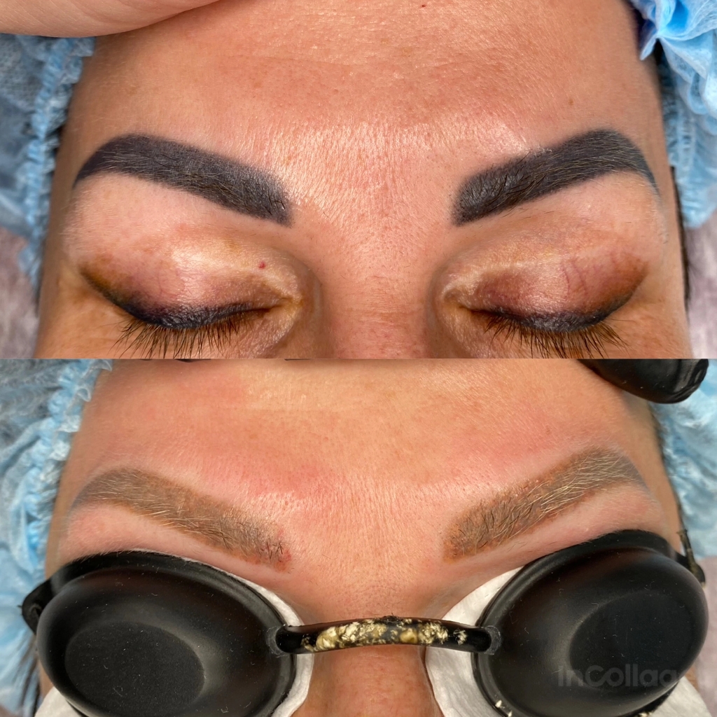 Удаление ПМ бровей