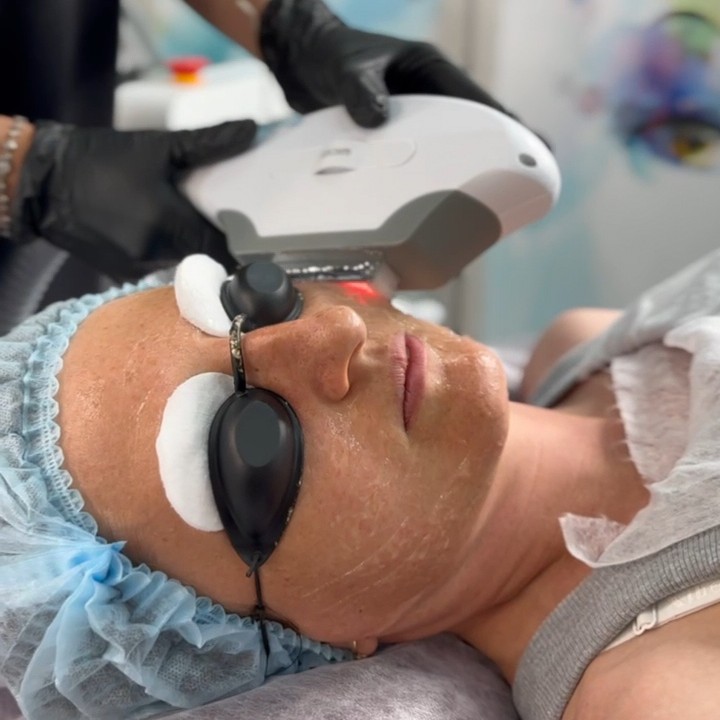 Фотоомоложение + Rf лифтинг лицо