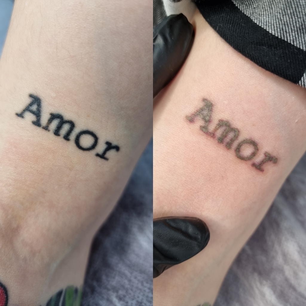 Удаление тату