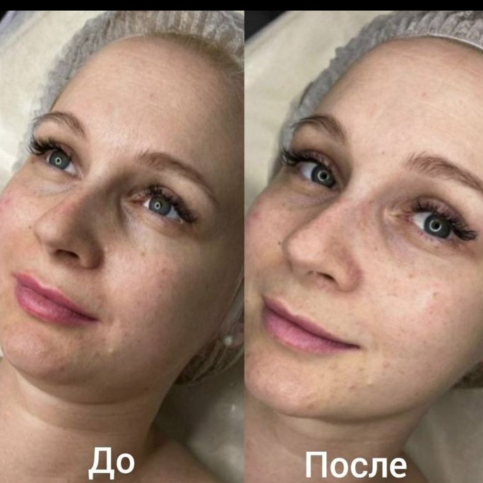 Нанесение альгинатной маски