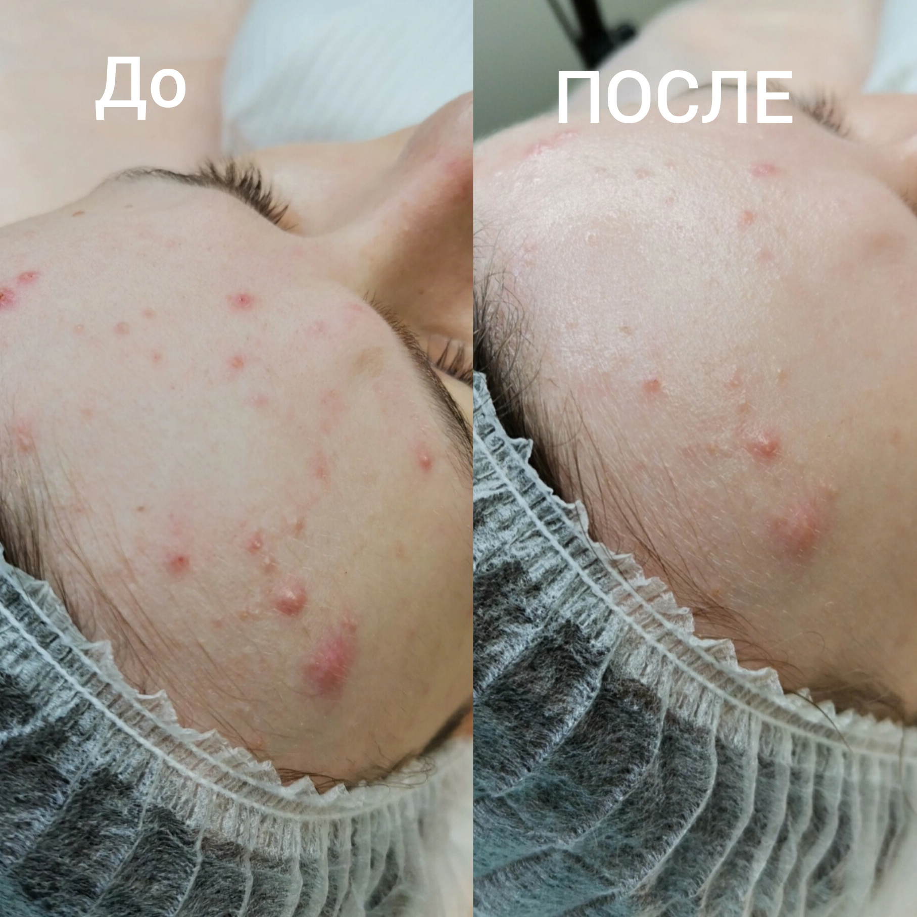 Чистка лица глубокая с  пилингом