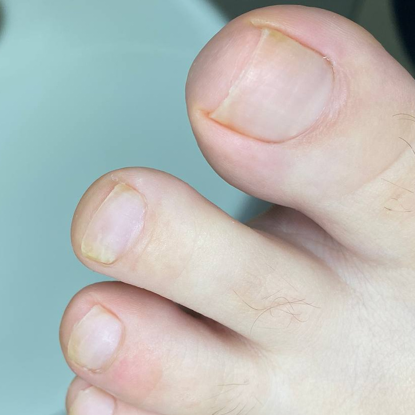 Подологический педикюр