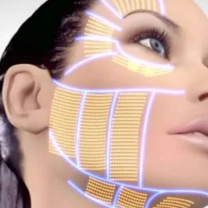 Динамический SMAS-лифтинг лица