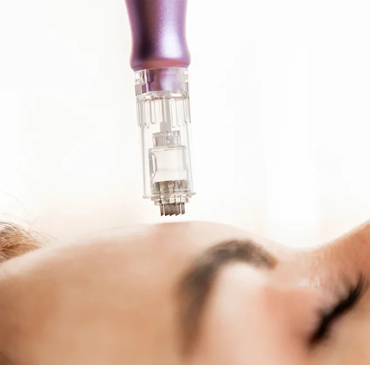 Фракционная мезотерапия