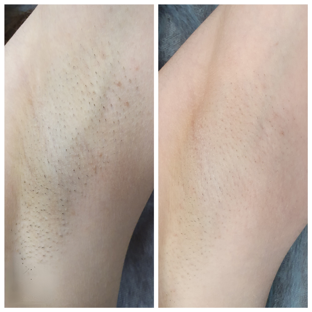 Подмышечные впадины