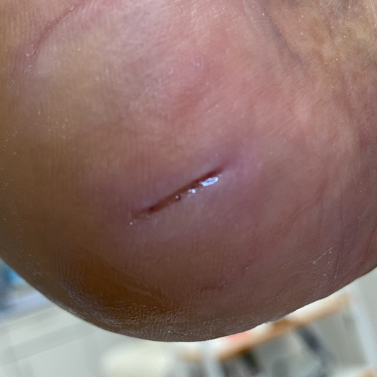 Подологический уход любой сложности.  В комплекс входит обработка стопы и пальчиков,консультация подолога