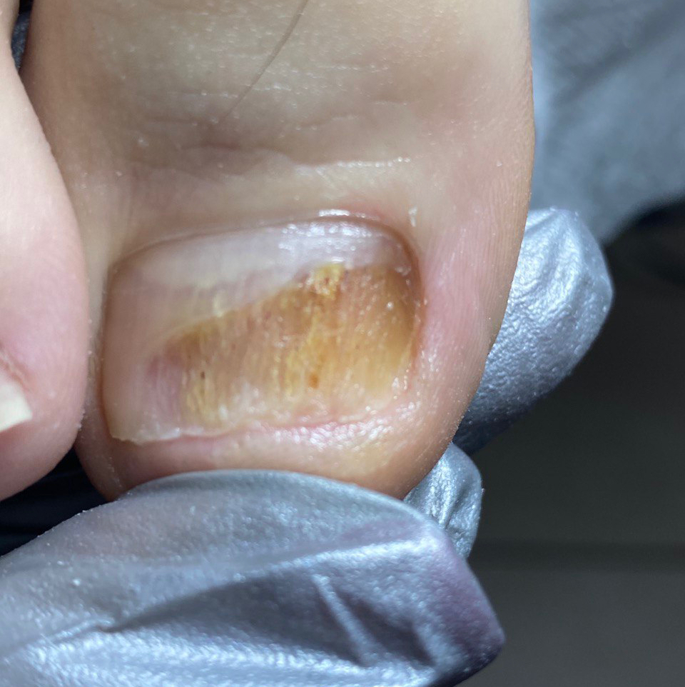 Обработка ногтей пораженных грибковой инфекцией  1 ноготь от 500₽  Два и более от 1500₽