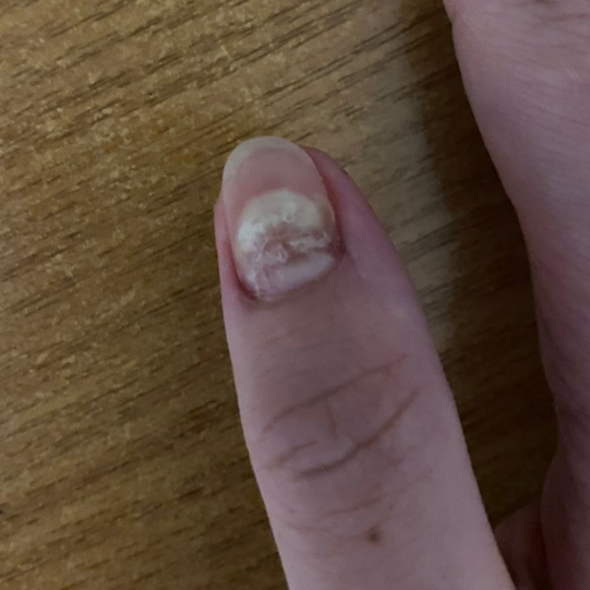 Обработка онихолизиса. В комплекс  входит обработка онихолизиса,консультация подолога,диагностика обуви,стопы,носочно-чулочных изделий