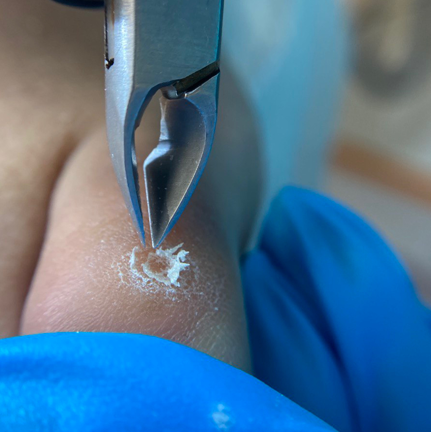 Обработка мозолей и омозолелостей. В комплекс входит обработка и консультация подолога