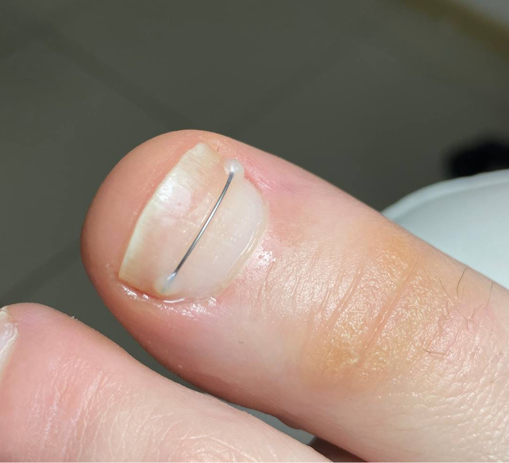 Установка коррекционной системы на деформированные ногтевые пластины