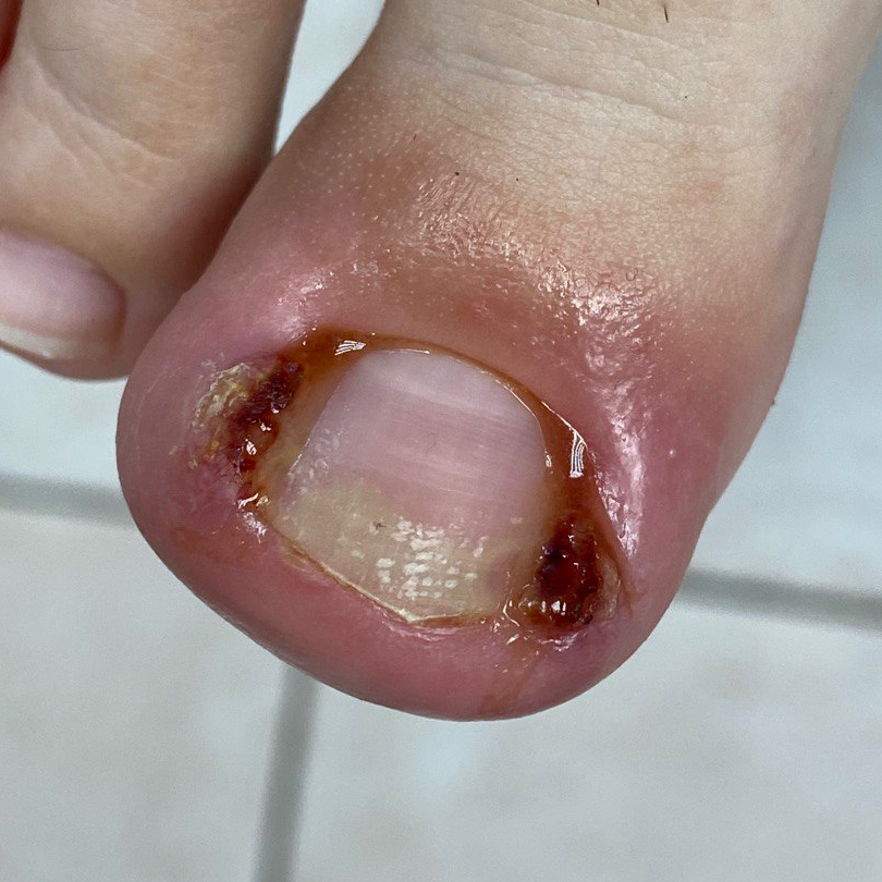 Работа с вросшим ногтем любой сложности без боли и операции